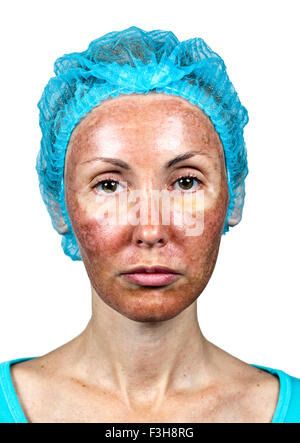 La cosmetologia. Nuova pelle dopo un peeling chimici, un arrossamento a causa del troppo veloce eliminazione di un vecchio strato. Foto Stock