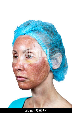 La cosmetologia. Nuova pelle dopo un peeling chimici, un arrossamento a causa del troppo veloce eliminazione di un vecchio strato. Foto Stock