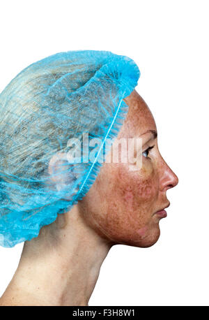 La cosmetologia. Nuova pelle dopo un peeling chimici, un arrossamento a causa del troppo veloce eliminazione di un vecchio strato. Foto Stock
