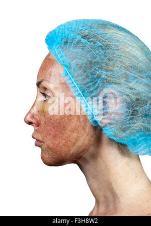La cosmetologia. Nuova pelle dopo un peeling chimici, un arrossamento a causa del troppo veloce eliminazione di un vecchio strato. Foto Stock