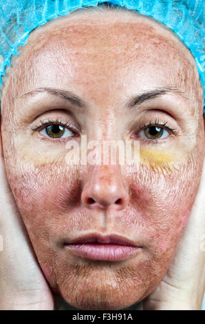 La cosmetologia. Nuova pelle dopo un peeling chimici, un arrossamento a causa del troppo veloce eliminazione di un vecchio strato. Foto Stock