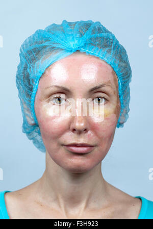 La cosmetologia. Nuova pelle dopo un peeling chimici, un arrossamento a causa del troppo veloce eliminazione di un vecchio strato. Foto Stock