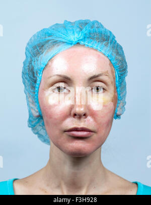 La cosmetologia. Nuova pelle dopo un peeling chimici, un arrossamento a causa del troppo veloce eliminazione di un vecchio strato. Foto Stock