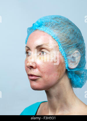 La cosmetologia. Nuova pelle dopo un peeling chimici, un arrossamento a causa del troppo veloce eliminazione di un vecchio strato. Foto Stock