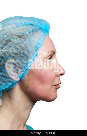 La cosmetologia. Nuova pelle dopo un peeling chimici, un arrossamento a causa del troppo veloce eliminazione di un vecchio strato. Foto Stock