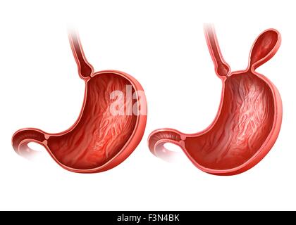 Stomaco con e senza ernia Foto Stock