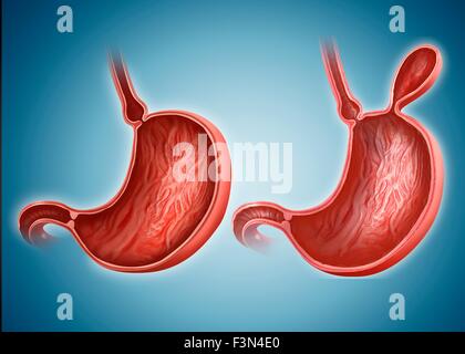 Stomaco con e senza ernia Foto Stock