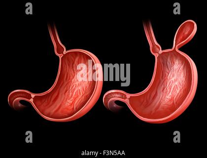 Stomaco con e senza ernia Foto Stock