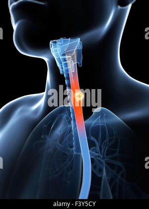 3d reso illustrazione di esophagus cancer Foto Stock