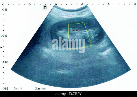 Litiasi renale, ultrasuoni Foto Stock