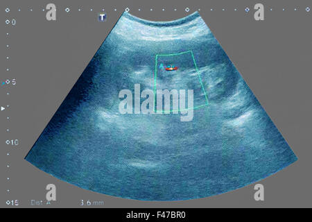 Litiasi renale, ultrasuoni Foto Stock
