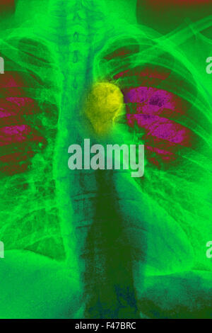 AORTA ATEROMATOSE, X-RAY Foto Stock