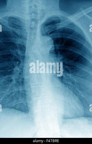 AORTA ATEROMATOSE, X-RAY Foto Stock