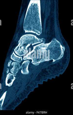 ENTHESOPATHY CT SCAN Foto Stock