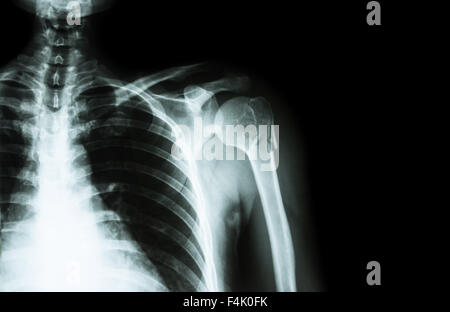 Frattura al collo di omero ( osso di braccio ) ( film x-ray spalla sinistra e la zona vuota a destra ) Foto Stock
