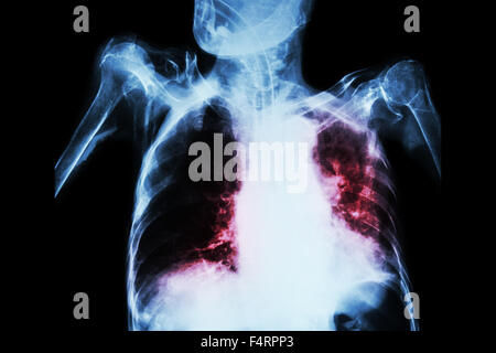 La tubercolosi polmonare con insufficienza respiratoria acuta ( pellicola i raggi x al torace del paziente vecchio show e alveolari infiltrat interstiziale Foto Stock