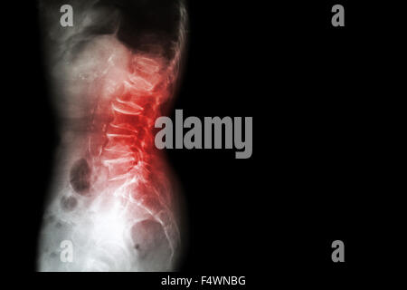 Spondilosi , Spondylolisthesis ( Film x-ray lombo-sacrale mostrano rachide dorso collasso , diminuzione di spazio su disco , sperone osseo forma Foto Stock