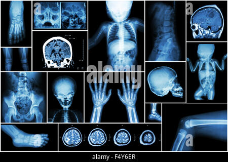 X-ray più parte del bambino 's body & più malattia ( corsa , tumore al cervello , artrite reumatoide , sinusite , gouty arthri Foto Stock