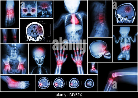 X-ray più parte del bambino 's body & più malattia ( corsa , tumore al cervello , artrite reumatoide , sinusite , gouty arthri Foto Stock