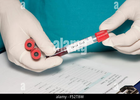 Provetta per la raccolta di sangue con il virus di Ebola etichetta di prova tenuto dal tecnico. Etichetta creata dal fotografo. Foto Stock