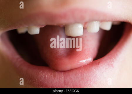 Gap-dentata dentizione primaria di un 7 anno di old boy Foto Stock