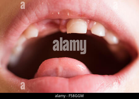 Gap-dentata dentizione primaria di un 7 anno di old boy Foto Stock