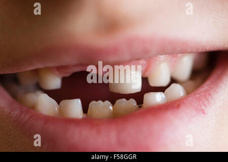 Gap-dentata dentizione primaria di un 7 anno di old boy Foto Stock