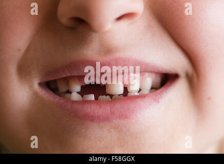 Gap-dentata dentizione primaria di un 7 anno di old boy Foto Stock