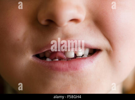 Gap-dentata dentizione primaria di un 7 anno di old boy Foto Stock