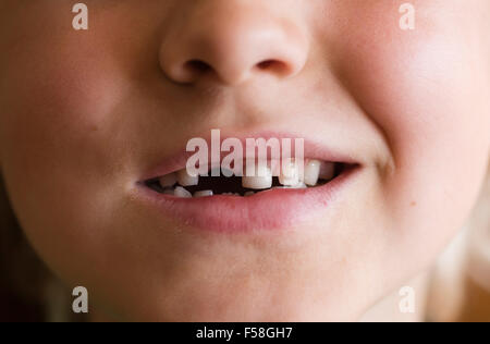 Gap-dentata dentizione primaria di un 7 anno di old boy Foto Stock