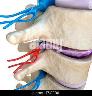 Il midollo spinale sotto pressione di rigonfiamento disc Foto Stock