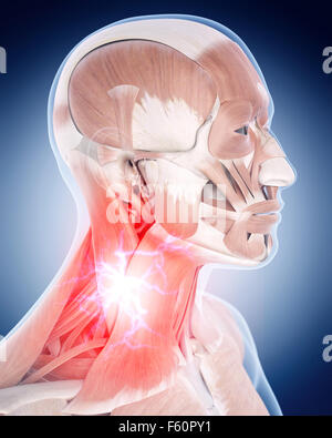 Medical 3d illustrazione di un doloroso collo Foto Stock