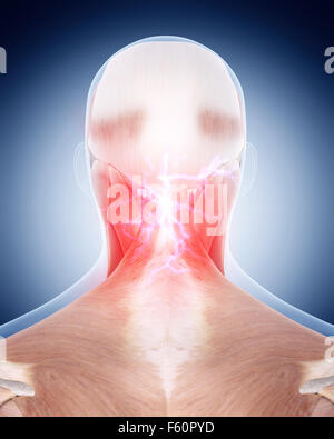 Medical 3d illustrazione di un doloroso collo Foto Stock
