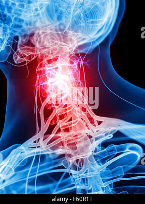 Dal punto di vista medico illustrazione accurata di dolorose nervi cervicali Foto Stock