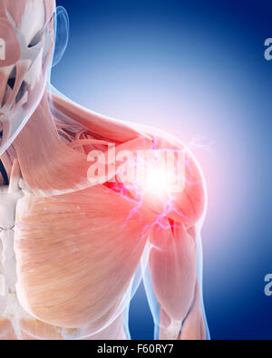 Medical 3d illustrazione di una spalla dolorosa Foto Stock