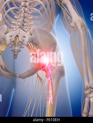 Dal punto di vista medico illustrazione accurata di un doloroso il nervo sciatico Foto Stock