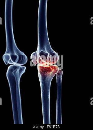 Anatomia ossa artrosi del ginocchio umano scheletro della gamba Foto Stock