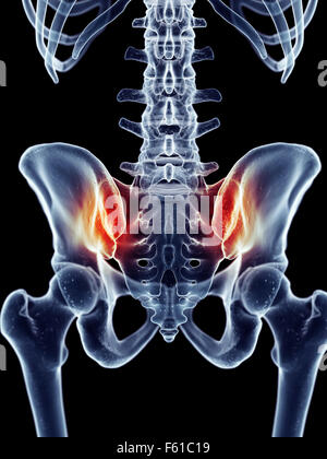 Dal punto di vista medico illustrazione accurata - dolorosa sacroiliac joint Foto Stock