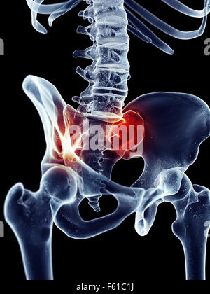 Dal punto di vista medico illustrazione accurata - dolorosa sacroiliac joint Foto Stock