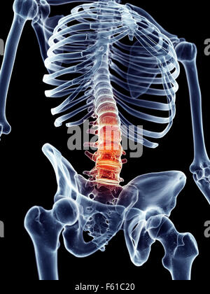 Dal punto di vista medico illustrazione accurata - dolorosa della colonna vertebrale lombare Foto Stock