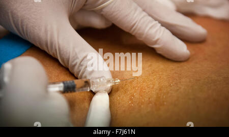 Reportage su un GP che utilizza la mesoterapia a Ginevra, Svizzera. La mesoterapia è un trattamento medico che consiste nel somministrare la medicina attraverso micro-iniezioni nella pelle. Qui il medico inietta un paziente con acido ialuronico. Foto Stock