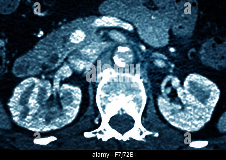 Calcificazione arteriosa CT SCAN Foto Stock