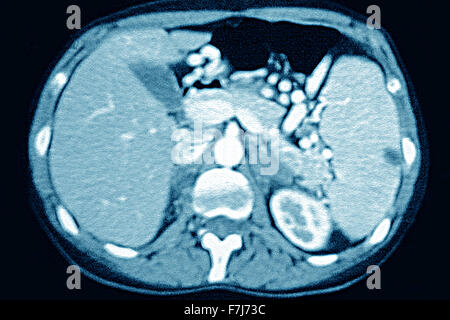 La milza miocardico CT SCAN Foto Stock