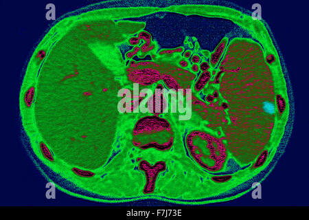 La milza miocardico CT SCAN Foto Stock