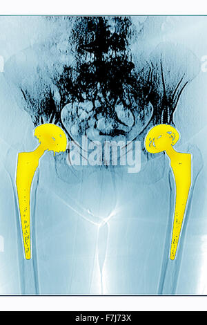 Protesi dell'anca, X-RAY Foto Stock