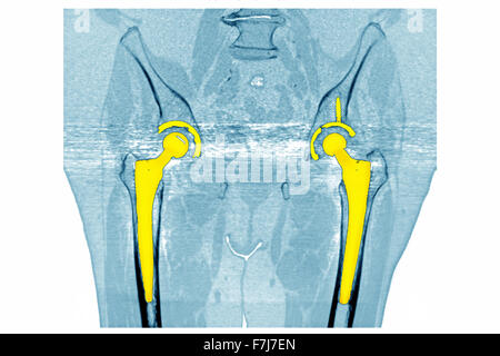 Protesi dell'anca, scansione TC Foto Stock