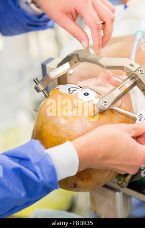Il trattamento chirurgico del morbo di Parkinson da profonda stimolazione cerebrale con Rosa ® robot, ospedale di Amiens, Francia. Foto Stock