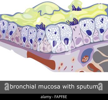 Struttura del danneggiato nella mucosa bronchiale con sputo, illustrazione vettoriale Illustrazione Vettoriale