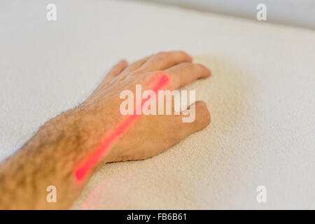 Il trattamento di fisioterapia con laser sulla mano del Caucaso Foto Stock