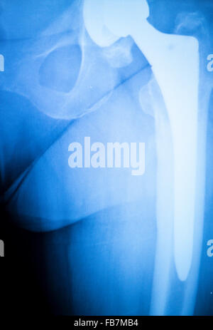 Anca artritiche xray scansione di prova ortopedia e traumatologia risultati che mostrano il titanio anca la piastra e le viti impianto chirurgico. Foto Stock